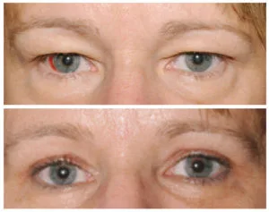 Best eyebrow lift treatment in gurgaon at best prices