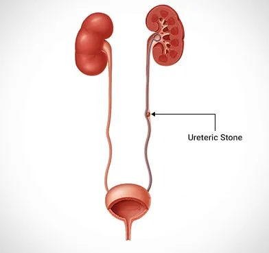 Ureteric stone surgery in delhi - delhi urology hospital