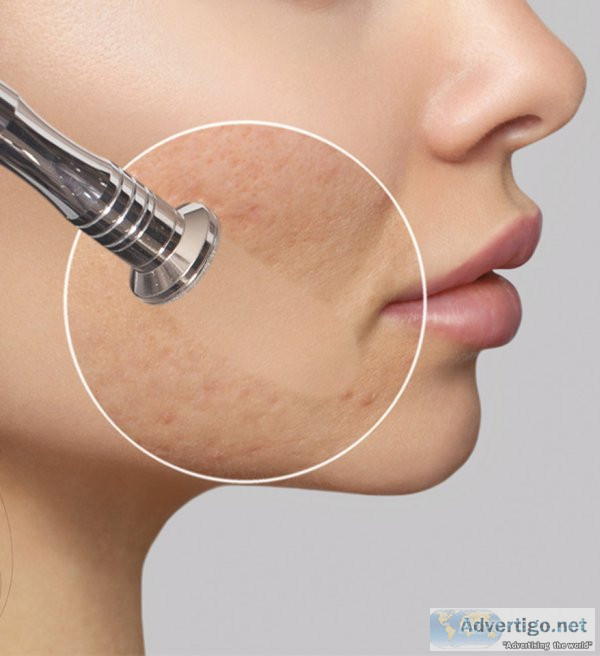 Laser hair removal treatment