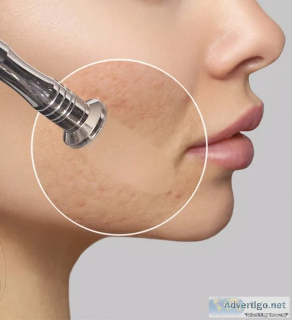 Laser hair removal treatment