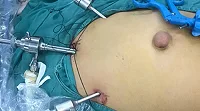 Best hospital for hernia surgery in ahmedabad