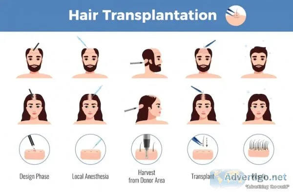 A perfect guide to hair loss treatment in pune