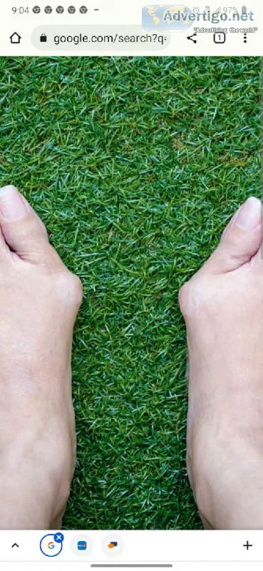 Looking For People With Bunions