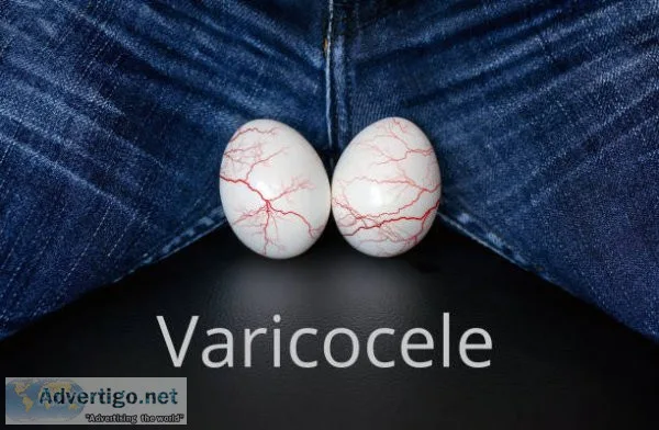 Advanced varicocele surgery in bhopal