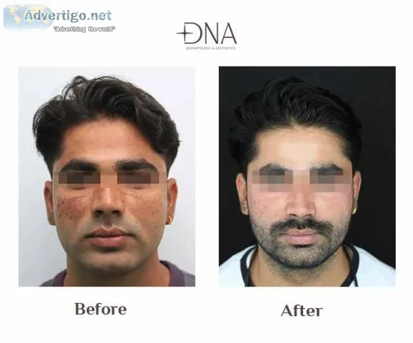 Pigmentation treatment: dna skin clinic