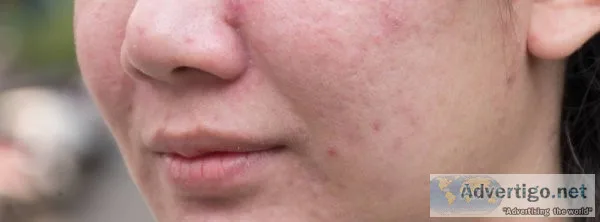 Best acne treatment in hyderabad: magna centre