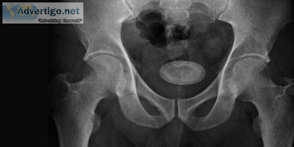 Bladder stone: causes, symptoms, diagnosis and treatment