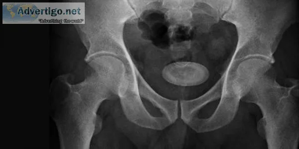 Bladder stone: causes, symptoms, diagnosis and treatment