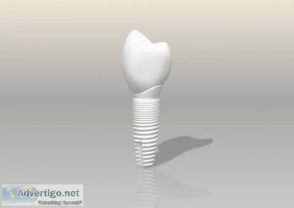Dental implant