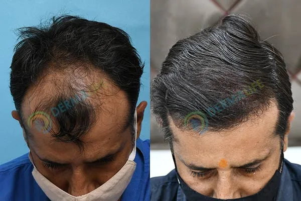 Best hair transplant in delhi | dermalife