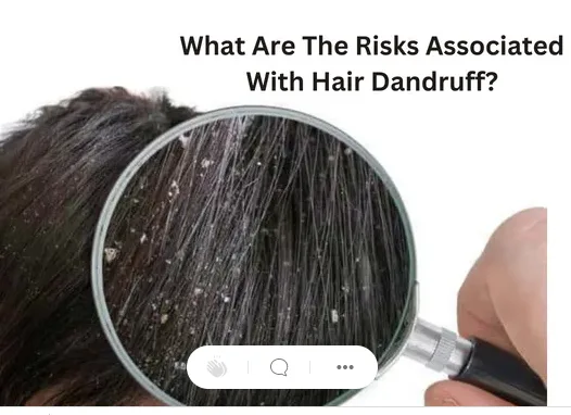 What risks of dandruff are associated with it?
