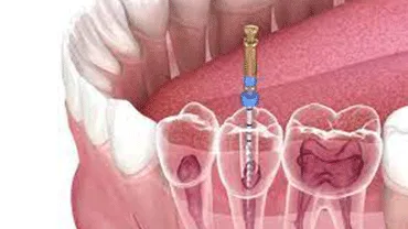 Painless root canal treatment in thakur village mumbai