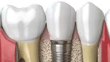 Quality implant treatments at the best implant clinic in thakur 