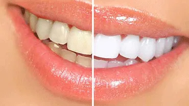 Teeth bleaching treatment clinic in thakur village mumbai india