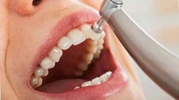 Teeth cleaning treatment in thakur village mumbai, india