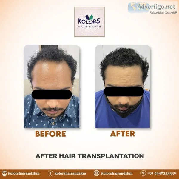 Transform your look with best hair transplant in hyderabad
