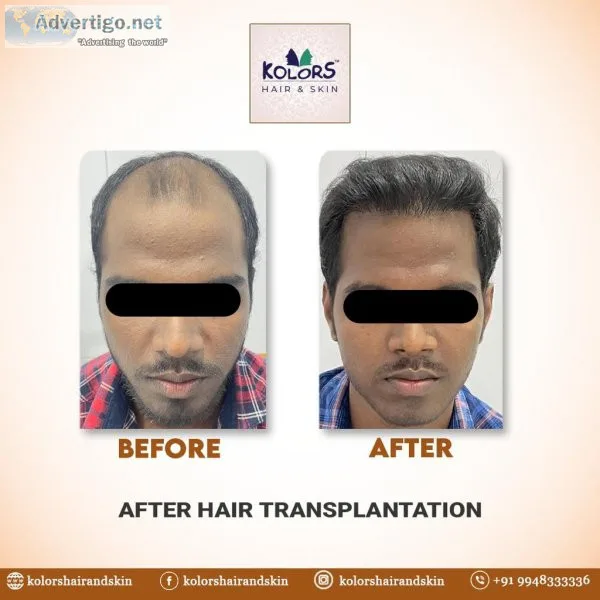 Transform your look with best hair transplant in hyderabad