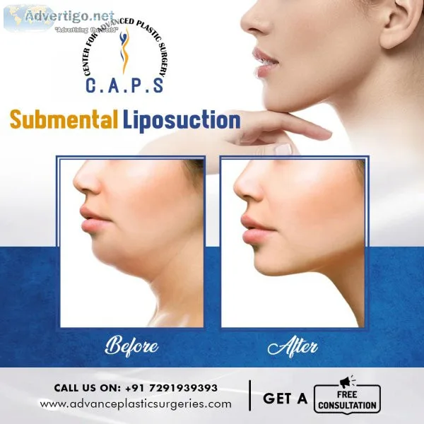 Liposuction surgery in south delhi