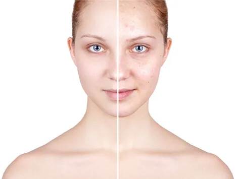 Laser acne scar removal cost in india