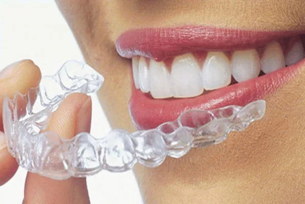 Clear aligners (invisalign, illusion)