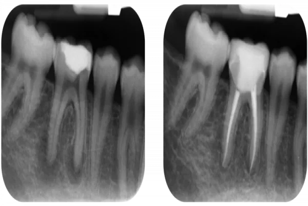 Root canal treatment