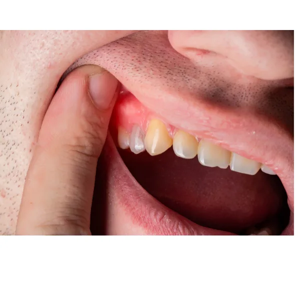 Gum treatment