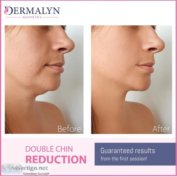 Double chin removal in delhi