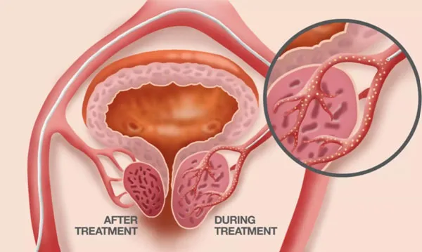 Uterine fibroid treatment in delhi