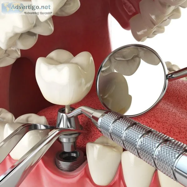 Dental implant treatment mumbai | are dental implants painful?