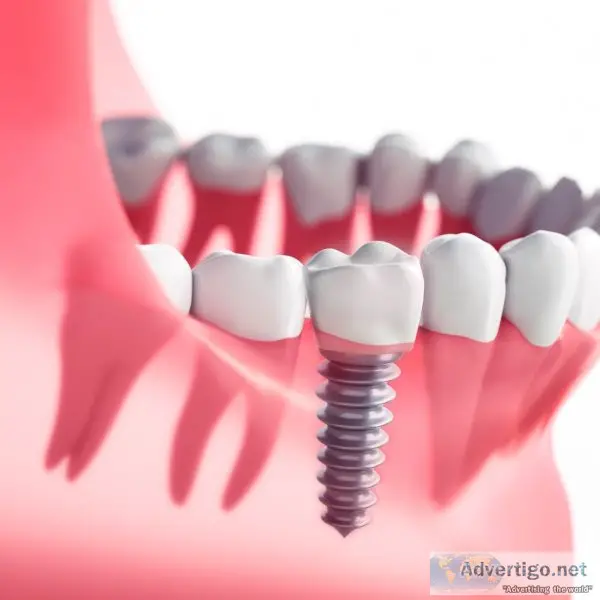 Dental implant treatment mumbai | are dental implants painful?