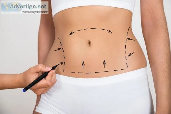 Liposuction surgery in delhi