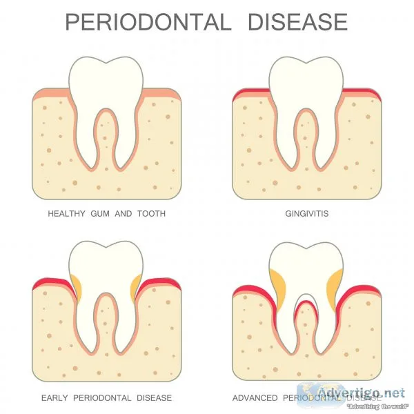 Effective gum disease treatment in singapore
