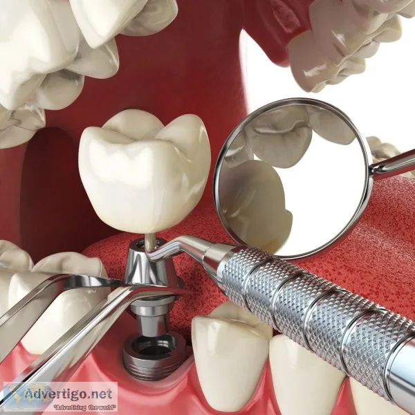 Dental implants