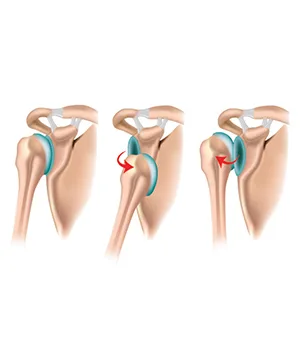 Doctor for shoulder replacement surgery in vadodara - vaishvi ho