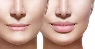 Best dermal fillers in dubai | la vida