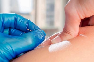 About ims/dry needling therapy