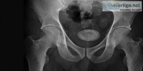 Dr niren rao: a well-known bladder stone specialist in delhi