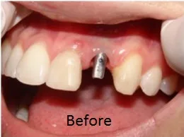 Trisa Dental Solutions : Best Dental Implants in Mumbai