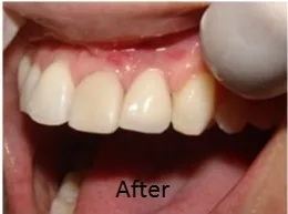 Trisa Dental Solutions : Best Dental Implants in Mumbai