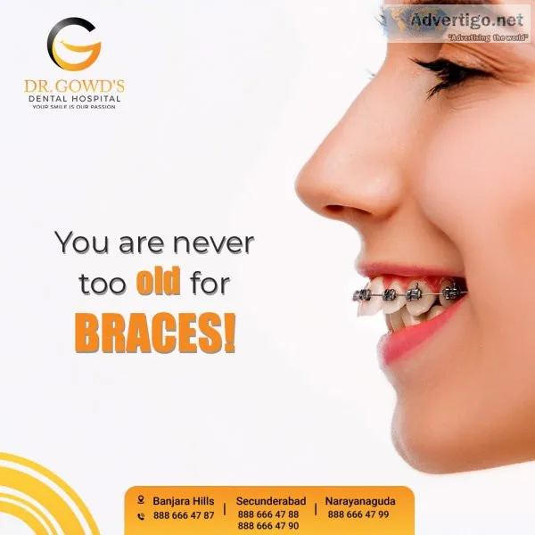 Best invisible braces in hyderabad