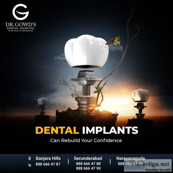 Best dental implants in hyderabad