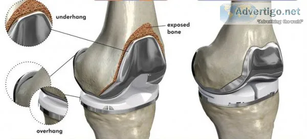 Best knee replacement surgeon in delhi ncr