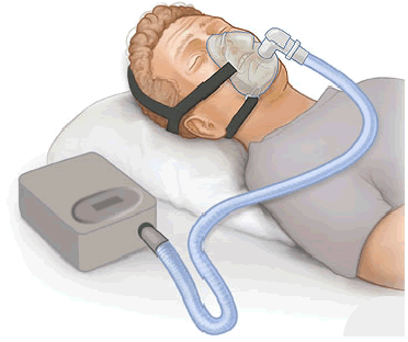 Sleep apnea treatment by dr sheetu singh