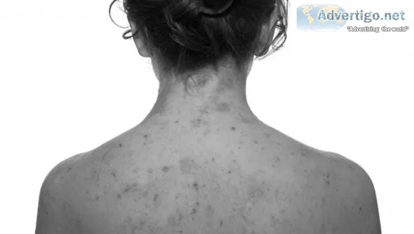 Discover relief for your skin allergies and eczema