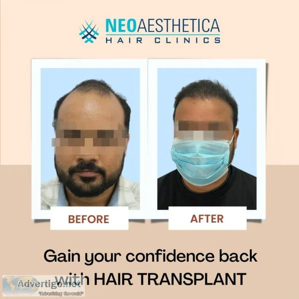 Discover lucknow s top hair transplant surgeon