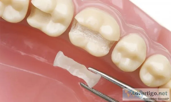 Tooth colored filling