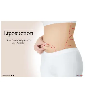 Liposuction