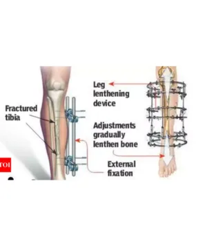 Limb lengthening surgery