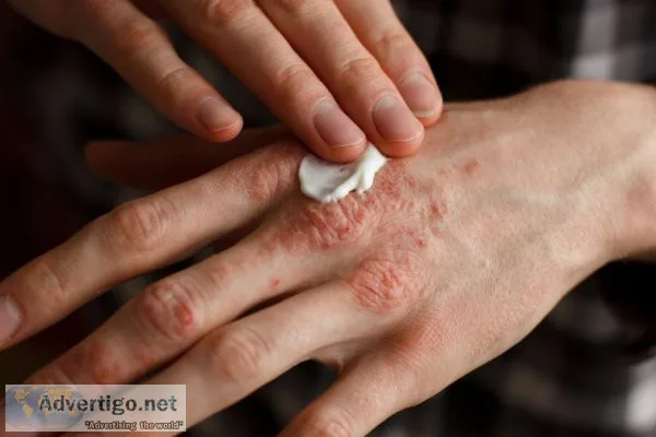 Best ayurvedic treatment for psoriasis: experience the differenc