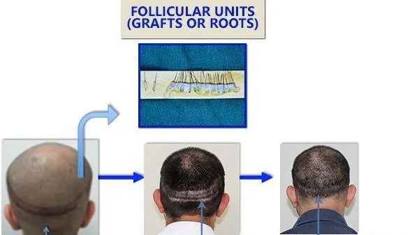Fut hair transplant in india